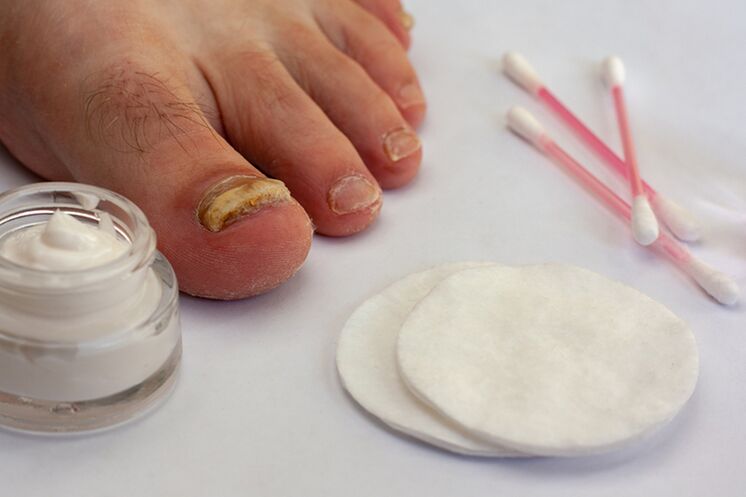 θεραπεία μυκήτων toe με κρέμα μύκητα