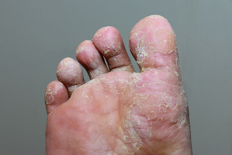 σοβαρό στάδιο μυκητίασης του δέρματος των ποδιών