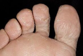 συμπτώματα μύκητα στο δέρμα των ποδιών