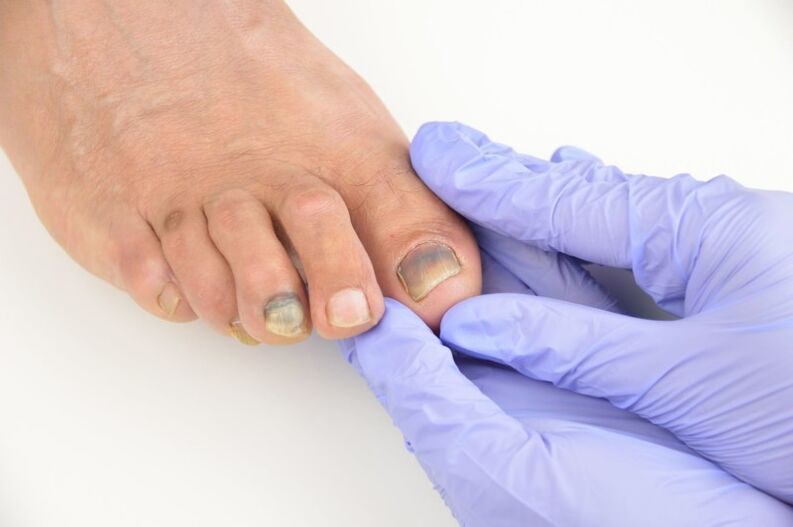 Ιατρική εξέταση των νυχιών των ποδιών που έχουν προσβληθεί από μύκητα