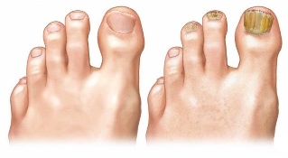 Υγιή και μολυσμένα το μύκητα toenail